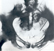 Pelvis_of_Albert_Fish_%28X-ray%29.jpg